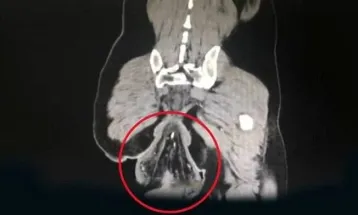 Ânus de homem cai após ele ficar na privada com celular por meia hora
