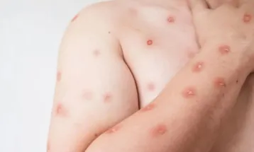 Mpox em 2026: Brasil registra 136 casos e nova variante liga alerta; veja sintomas